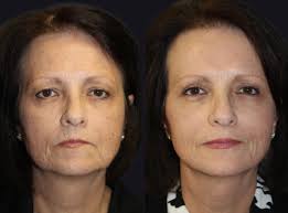 Unlock the Secrets to a Natural Facelift Without Surgery