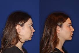 The Science of SMAS Facelift: Visual Results Before and After